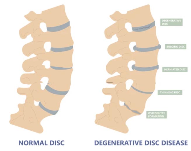 disk disease